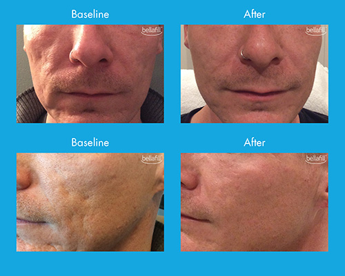 acne-scars-bellafill-total-med-solutions